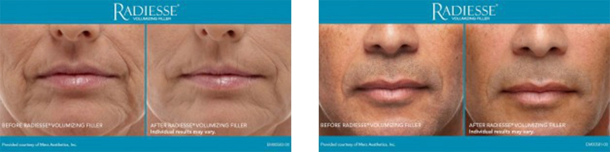 radiesse patient results