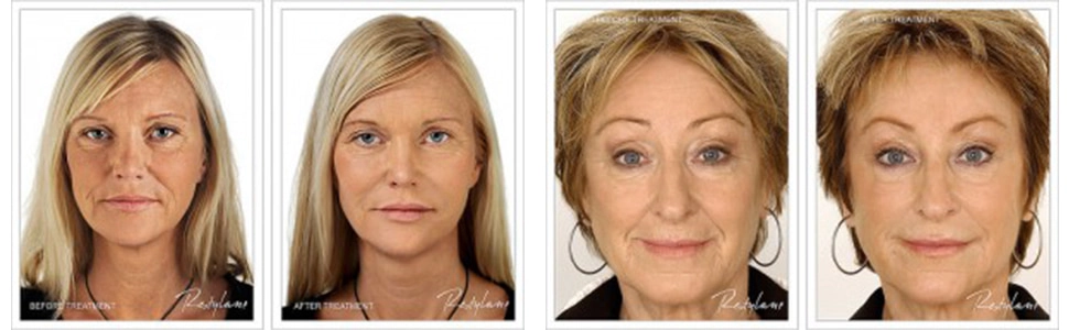 restylane patient results