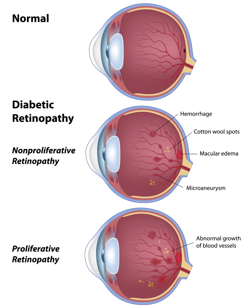 diabetic eye diagram showing different types of diabetic retinopathy