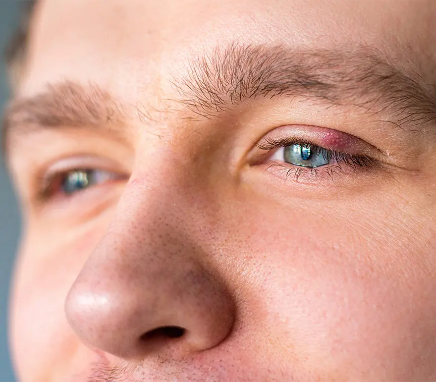 man with stye on upper eyelid